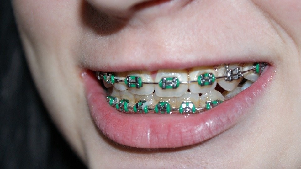 How to keep plaque off teeth with braces